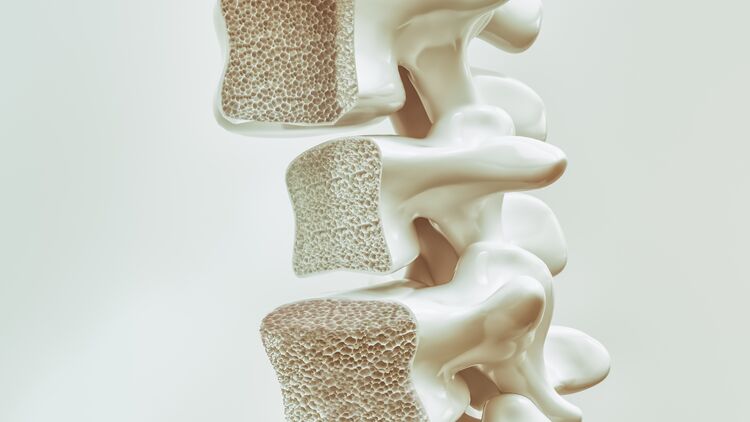 Osteoporosis on the spine - 3d rendering