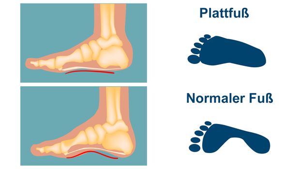 Plattfuß und normaler Fuß